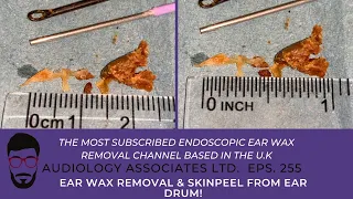 EAR WAX REMOVAL & SKIN PEEL FROM EARDRUM - EP 255