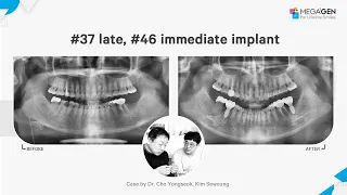 Dr. Yongseok CHO, Sewoung KIM, #37 late, #46 immediate implant surgery and prosthesis