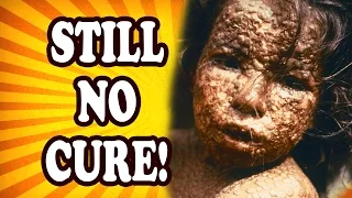 Top 10 Baffling Diseases We Still Don’t Have Cures For — TopTenzNet