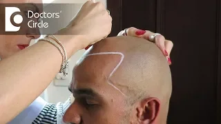 Is it better to get a hair transplant over many sessions? - Dr. K Prapanna Arya