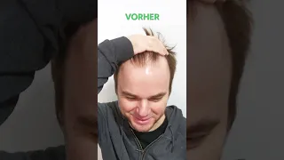 Haartransplantation vorher nachher: Gergely - PROHAARKLINIK #shorts