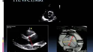 Echocardiographic assessment of bicuspid aortic valve