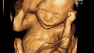 ULTRASSONOGRAFIA - 17 semanas gestação - 17weeks pregnancy - CLÍNICA SARRAFF ECOGRAFIA CURITIBA