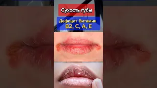 Без анализа: 5 симптомов дефицита витаминов!😱🧬👩🏻‍🔬Обратите внимание на эти симптомы