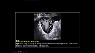 Gynecological Ultrasound -Lecture 04 -Ovaries  Part 2