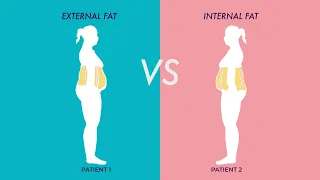 Removing Fat with LIPO - Internal Fat vs External Fat