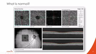 Interpreting Retinal OCTs & Introducing OCT-Angiography, Part 2 with Dr. Nathan Lighthizer