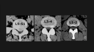 Normal anatomy of Spine imaging   for non arab