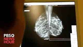 Mammograms should start at 40, government task force recommends