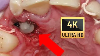 🤔HOW #BRACES WORK Amazing Impacted Canines - Explained💖 in 4K!  7-Year Follow-up❗💚