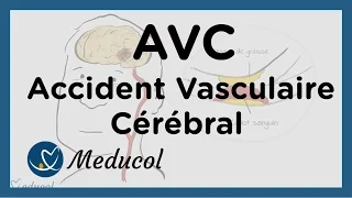 AVC : définition de l'AVC, symptômes et causes