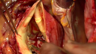 Aortic arch replacement with Thoraflex hybrid prosthesis.