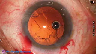 Management of a ROSETTE cataract : Pradip Mohanta, 12th April. 2022