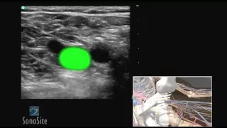 How To: Deep Vein Thrombosis Ultrasound Exam 3D Video