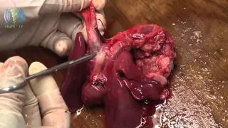 La autopsia de un recién nacido con displasia tanatofórica
