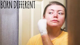 My Daily Battle With 'Butterfly Skin' | BORN DIFFERENT