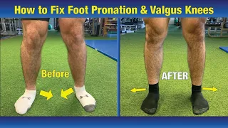 VERY EFFECTIVE Way to FIX Pronated feet & Knees Caving In (Valgus Knees)