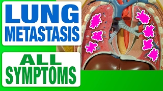 Lung Metastasis - All Symptoms