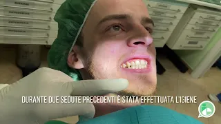 Dimostrazione faccette dentali – dr. Stefano Ottaviani