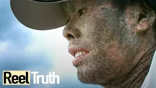 My Skin is Killing Me - Epidermolysis Bullosa | Extraordinary People Documentary | Reel Truth