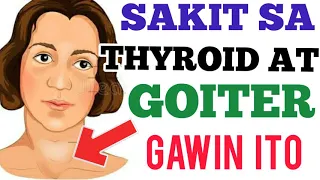 Goiter, Thyroid, Bukol: Kapain Ito! – by Doc Willie Ong #946