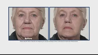 Fine lines and wrinkles can disappear with Plexaderm