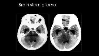 Dr Mamdouh Mahfouz Radiology Cousre Hydrocephalus