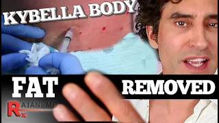 BODY FAT TREATMENT // Kybella