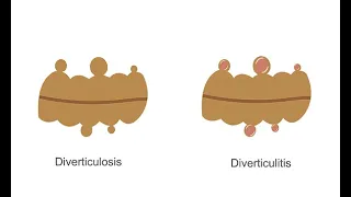 Evaluating acute diverticulitis