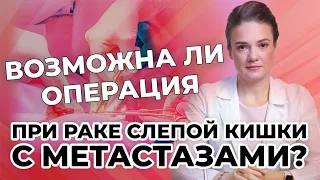 Возможна ли операция при раке слепой кишки с метастазами?