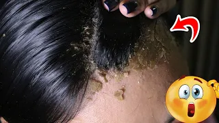 Ranking Scalp Dandruff Remove #151