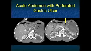 CT of the Acute Abdomen:GI Applications - Part 1