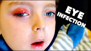 LITTLE BOY WITH KRABBE DISEASE BATTLES EYE INFECTION | Dr  Paul