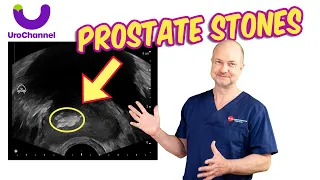 PROSTATE STONES – All you need to know! | UroChannel