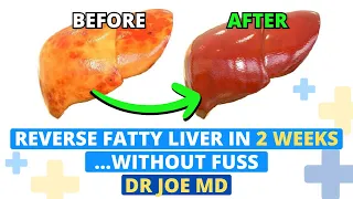 Reverse Fatty Liver FAST In 2 Steps