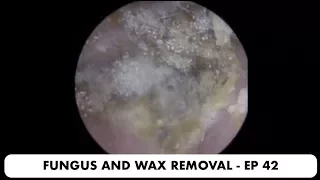 FUNGAL EAR INFECTION AND EAR WAX REMOVAL - EP 42