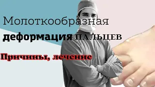 Молоткообразная деформация пальцев | Салли Олдер