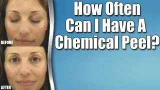 chemical peel Toorak: How often can I have chemical peels?