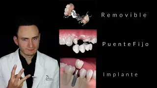 Puentes vs Implantes | ¿Cuál es la mejor opción? | Dentista en Querétaro