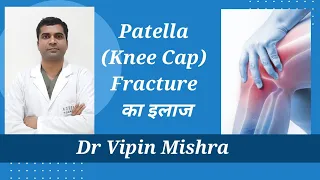 Treatment of knee Cap (patella) fracture.