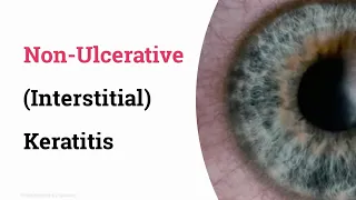 Non ulcerative interstitial keratitis