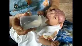 DVB TV News - A baby without skull born alive