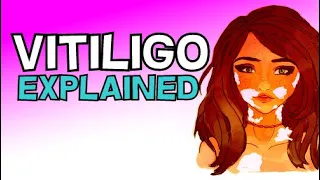 VITILIGO (SKIN DEPIGMENTATION) - CAUSES, AUTOIMMUNE, TREATMENT, SURGERY