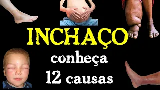 INCHAÇOS e Retenção de LÍQUIDOS: A Causa é SEMPRE Renal?