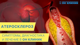 Атеросклероз: симптомы, диагностика и лечение в ОН КЛИНИК