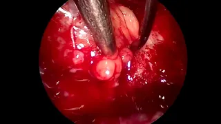 Endoscopic endo nasal cavernous hemangioma removal from the orbit
