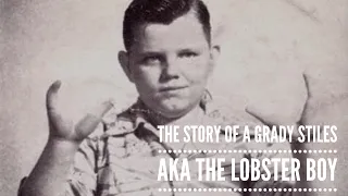 The Story of Grady Stiles AKA the Lobster Boy