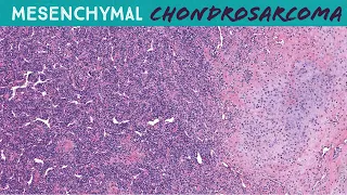 Mesenchymal Chondrosarcoma - round blue cell sarcoma with cartilage & staghorn vessels (UNC case 6)