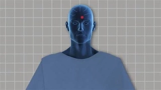 Deep Brain Stimulation: How It Works