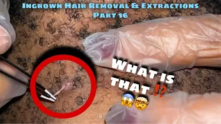 What is that⁉️😱| Ingrown Hair Removal & Exractions Part 16| Neck & Beard Area🔍